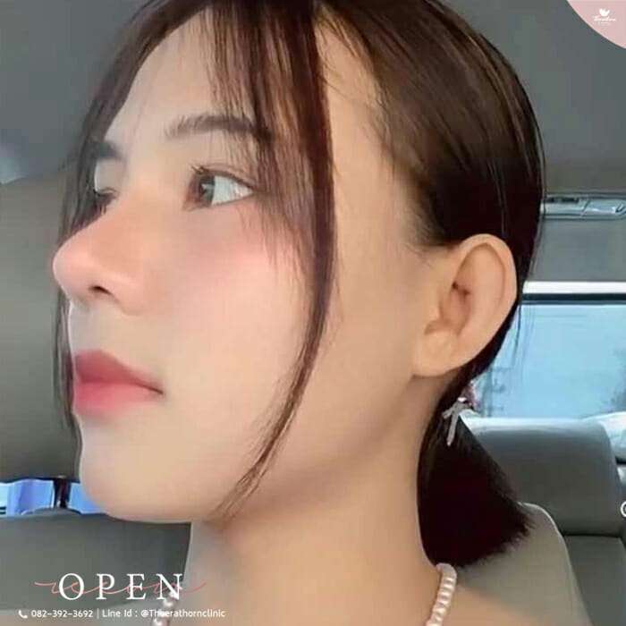 แก้จมูก, จมูกชมพู่, ปลายจมูกใหญ่