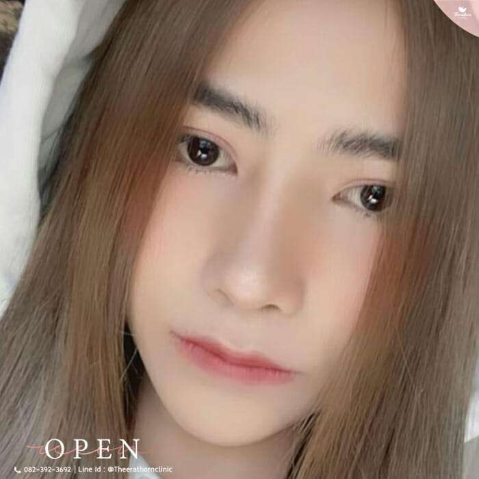 แก้จมูก, จมูกแกนกลางคดเอียง
