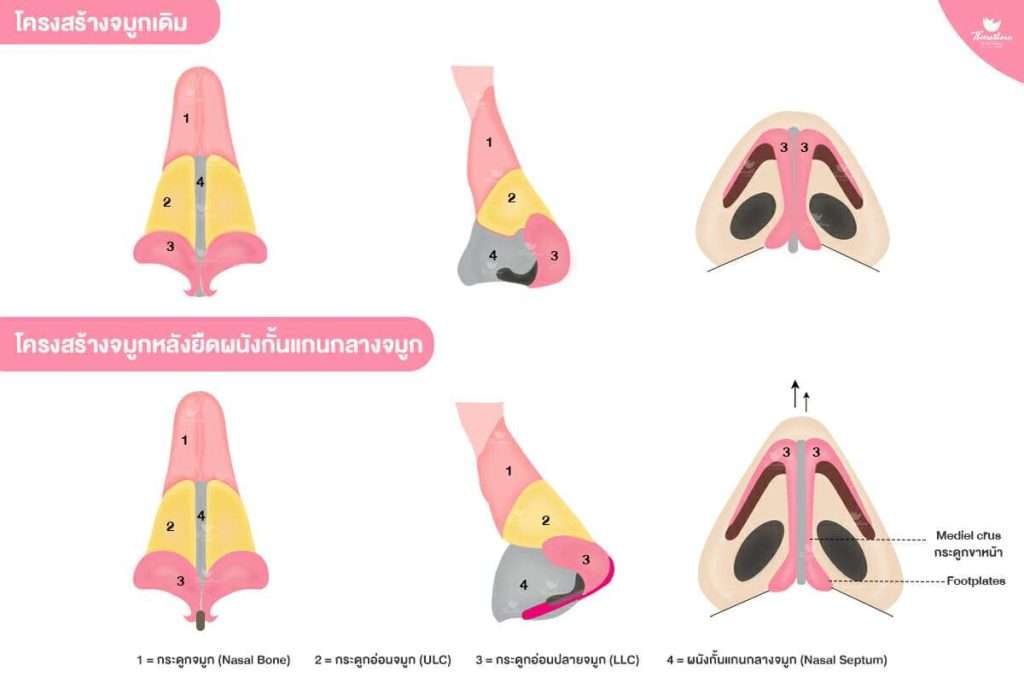 ยืดผนังกั้นแกนกลาง, โครงสร้างจมูก