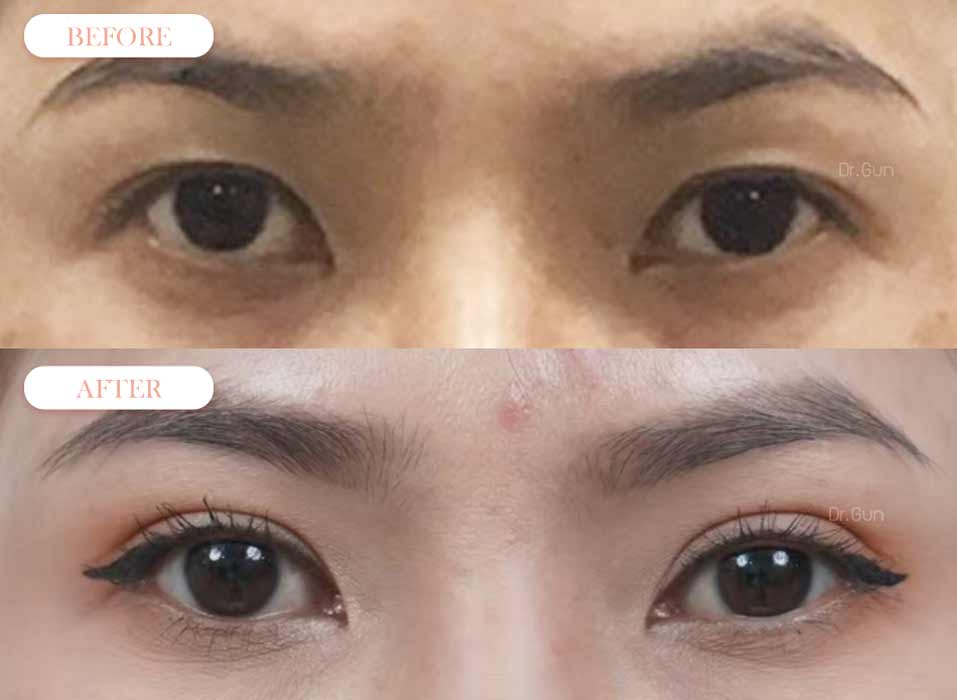 รีวิวตาสองชั้น