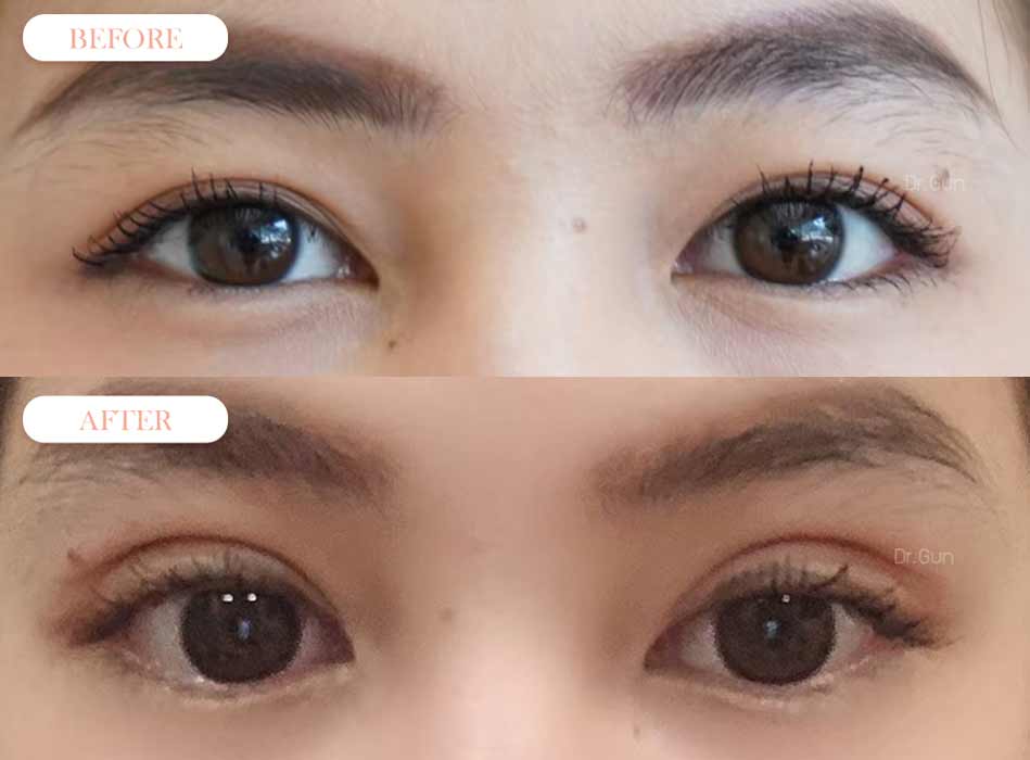 รีวิวตาสองชั้น