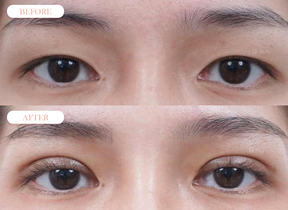 รีวิวตาสองชั้น