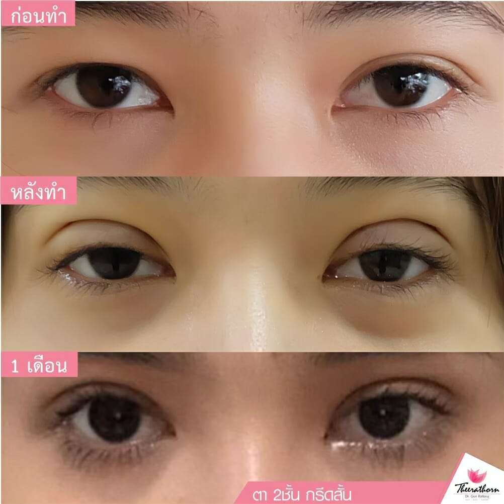รีวิวตาสองชั้นกรีดสั้น, ทำตา, แก้ตา