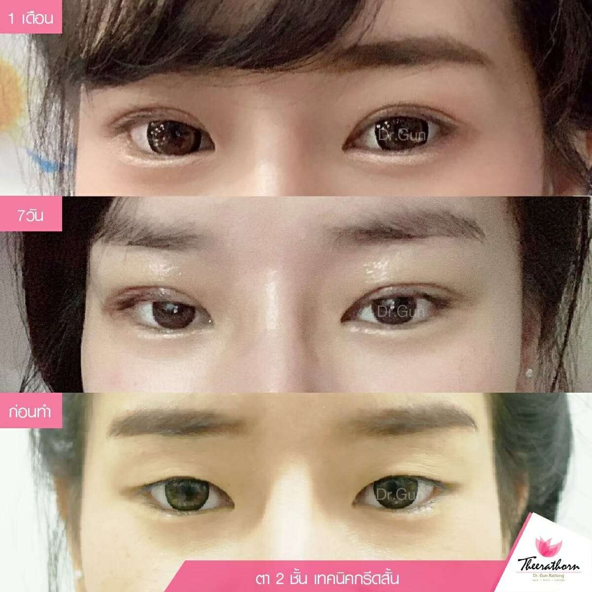 รีวิวตาสองชั้นกรีดสั้น, ทำตา, แก้ตา