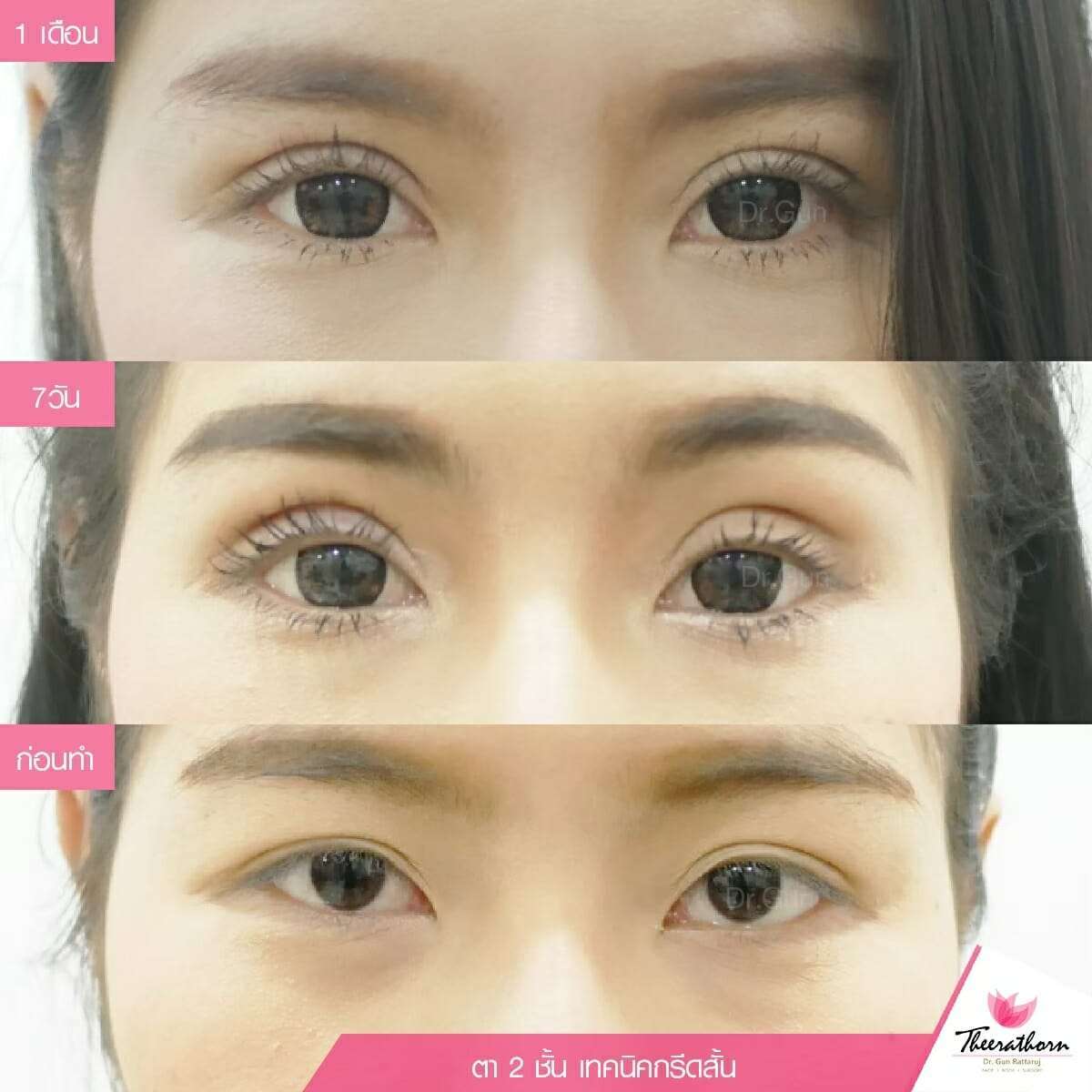 รีวิวตาสองชั้นกรีดสั้น, ทำตา, แก้ตา