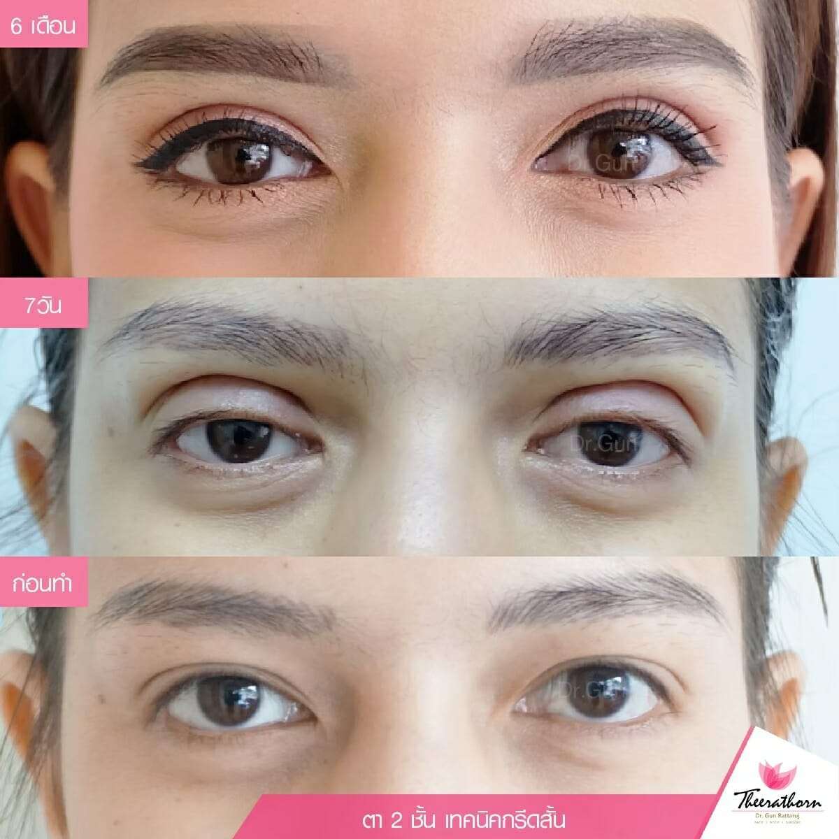 รีวิวตาสองชั้นกรีดสั้น, ทำตา, แก้ตา