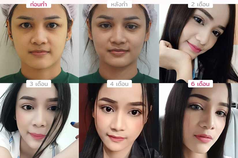 รีวิวตาสองชั้นกรีดยาว