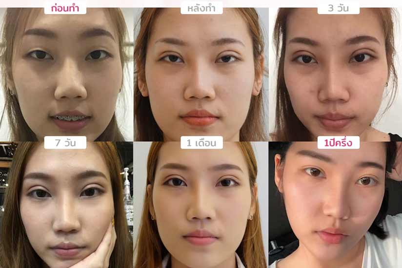 รีวิวตาสองชั้นกรีดยาว