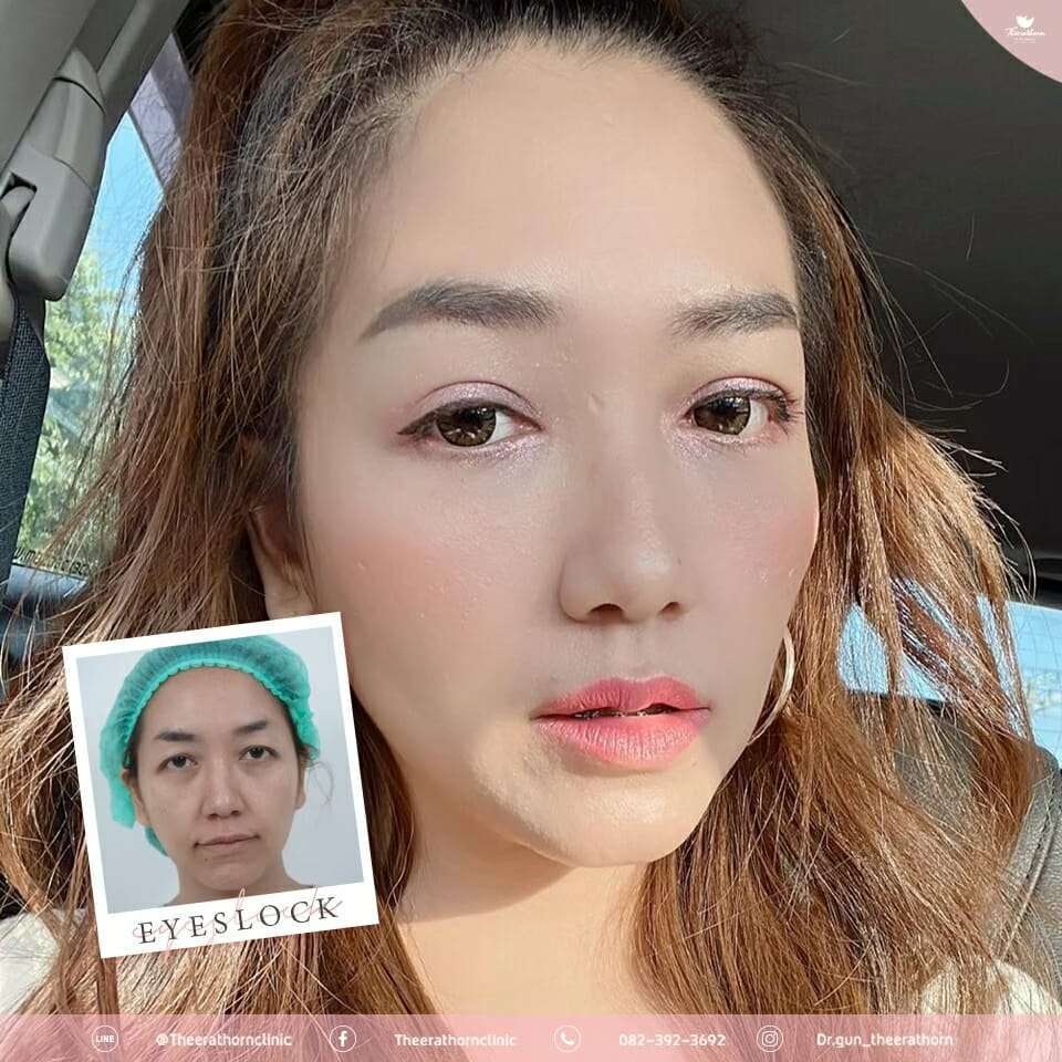 รีวิวตาสองชั้นกรีดยาว, หนังตาตก