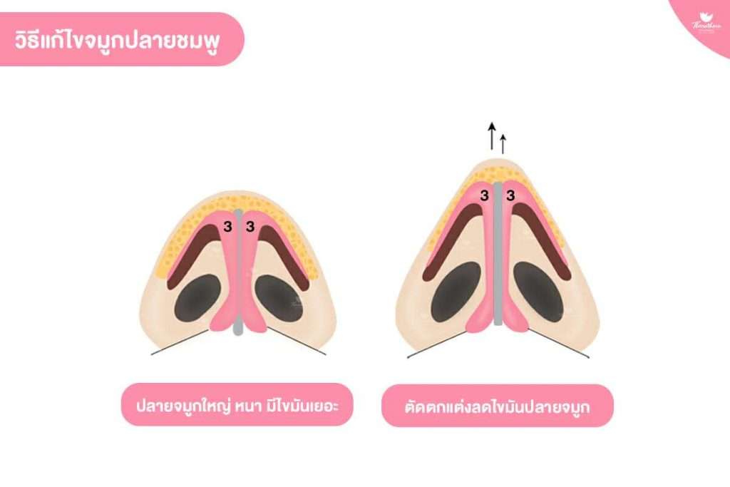จมูกชมพู่, จมูกหนา, ชั้นไขมันเยอะ