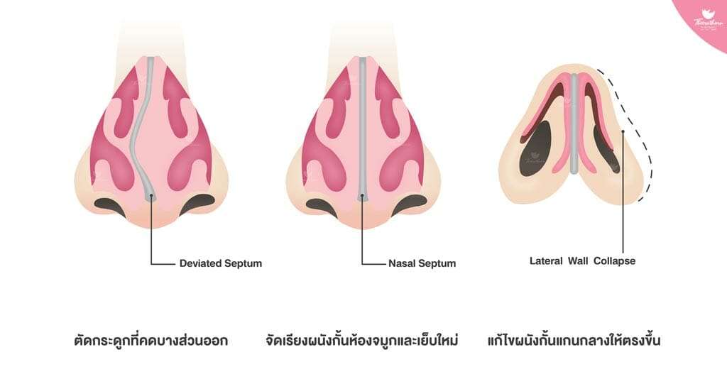 จมูกคด