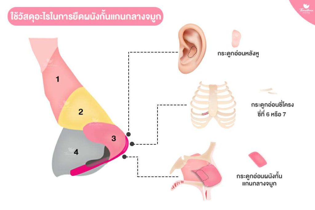 ยืดผนังกั้นแกนกลางจมูก, กระดูกอ่อนหลังหู, กระดูกอ่อนซี่โครง