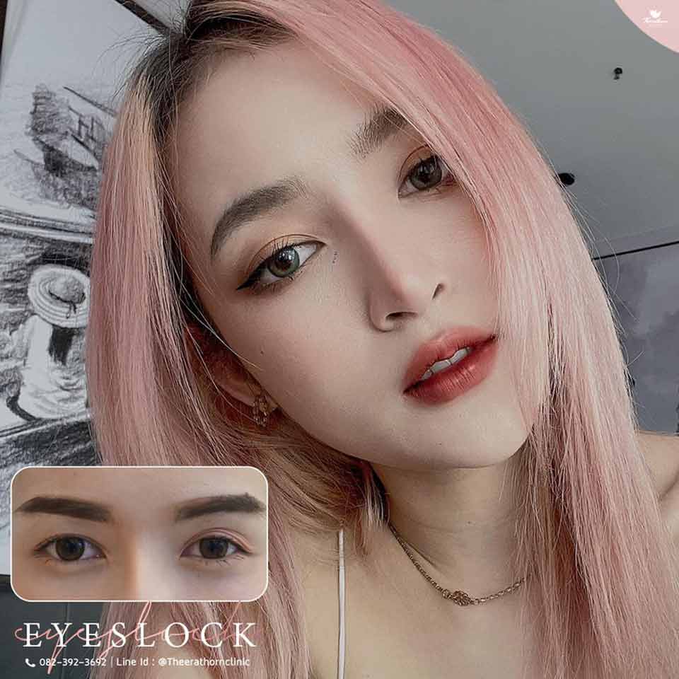 ตาสองชั้น, ชั้นตาไม่เท่ากัน, eyelock