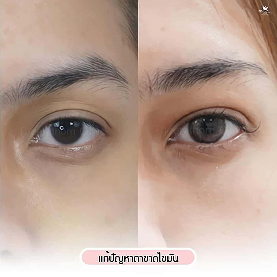 เติมไขมันตา, ฉีดไขมันตา, ตาขาดไขมัน