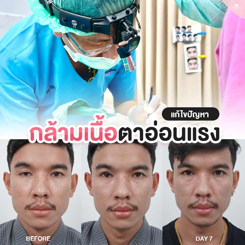 แก้ตา, กล้ามเนื้อตาอ่อนแรง