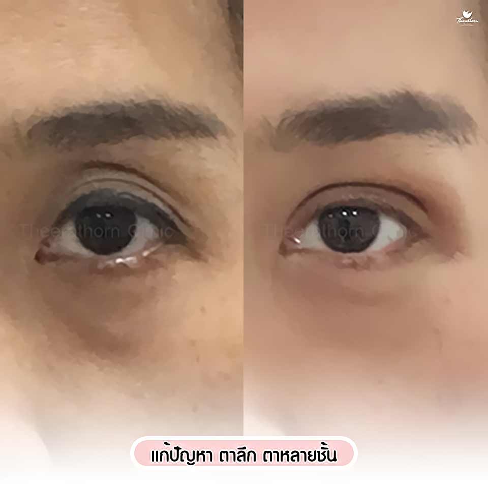 เติมไขมันตา, ฉีดไขมันตา, ตาลึก, ตาหลายชั้น