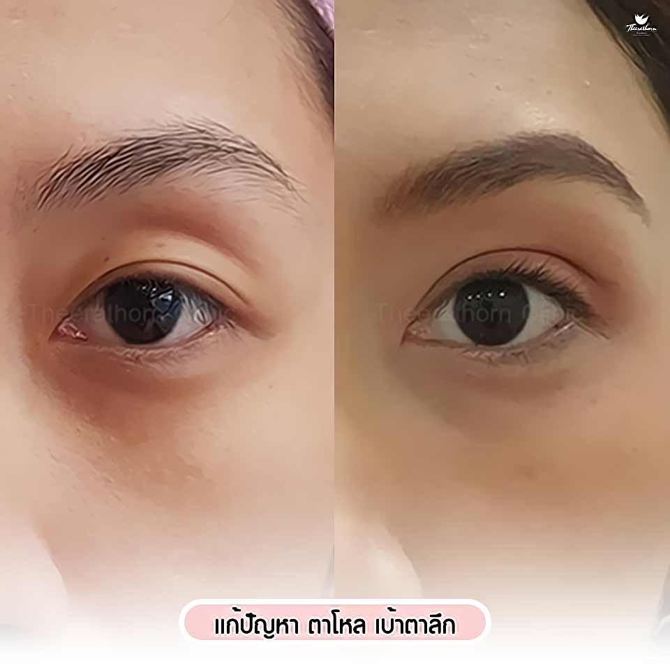 เติมไขมันตา, ฉีดไขมันตา, ตาโหล, เบ้าตาลึก