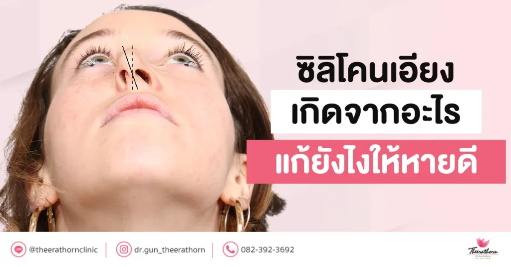 ซิลิโคนเอียง