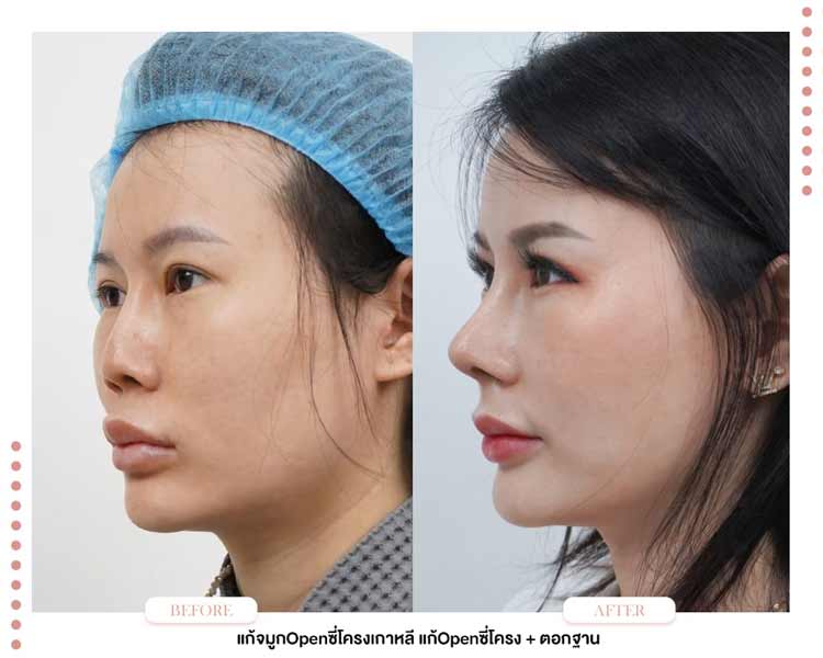 แก้จมูก, ทำจมูกโอเพ่น, ปัญหาจมูกสั้น