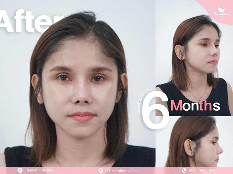 รีวิวแก้จมูก , ทรงแข็งทื่อ
