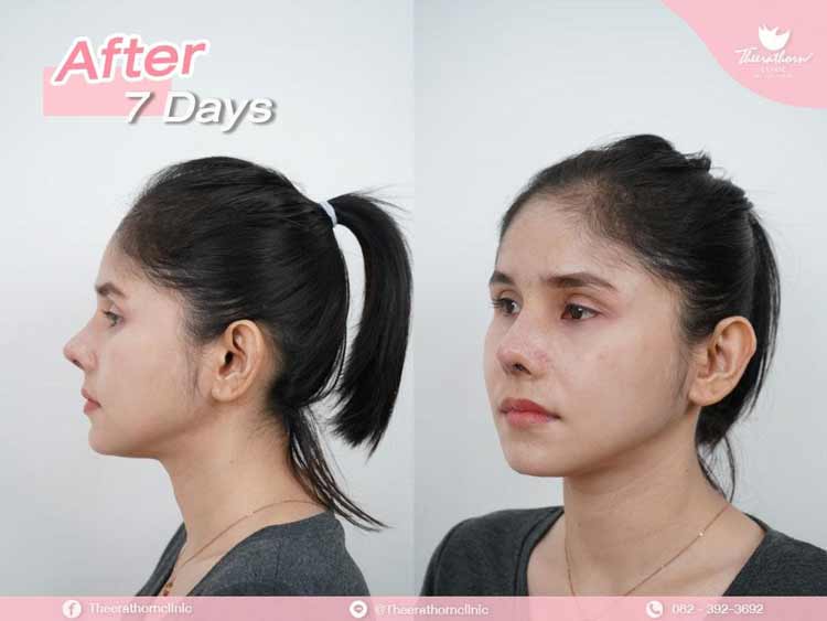 รีวิวแก้จมูก , ทรงแข็งทื่อ