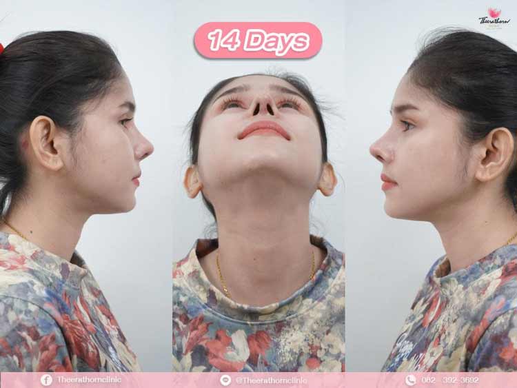 รีวิวแก้จมูก , ทรงแข็งทื่อ