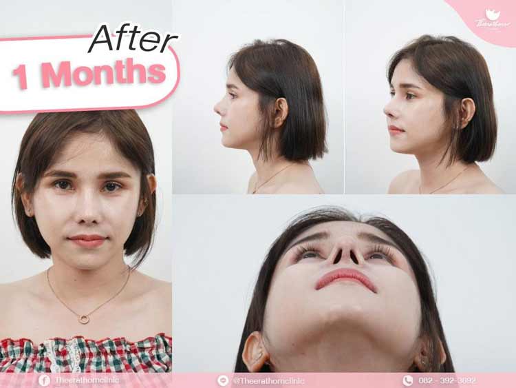 รีวิวแก้จมูก , ทรงแข็งทื่อ