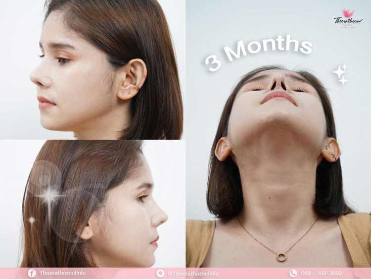 รีวิวแก้จมูก , ทรงแข็งทื่อ