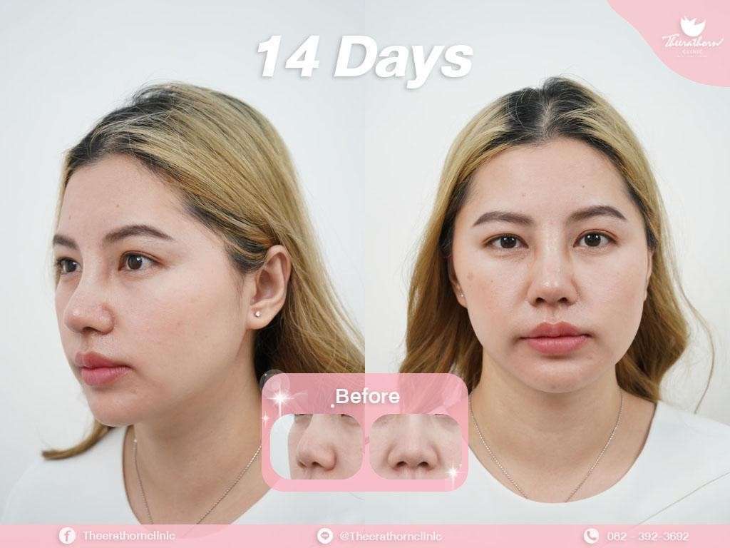 แก้จมูก , จมูกสั้น , กระดูกอ่อนหลังหู
