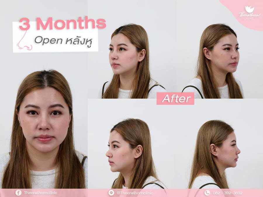แก้จมูก , จมูกสั้น , กระดูกอ่อนหลังหู
