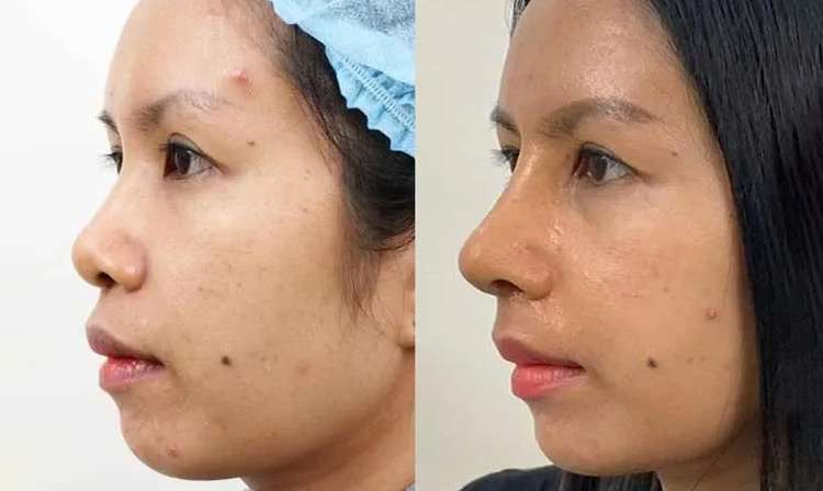 โอเพ่นซี่โครง , เสริมจมูก