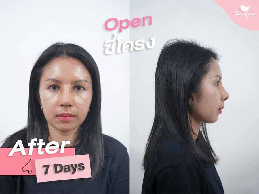 โอเพ่นซี่โครง , เสริมจมูก