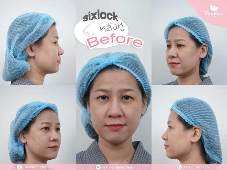 รีวิวแก้จมูก , กระดูกอ่อนหลังหู , sixlock