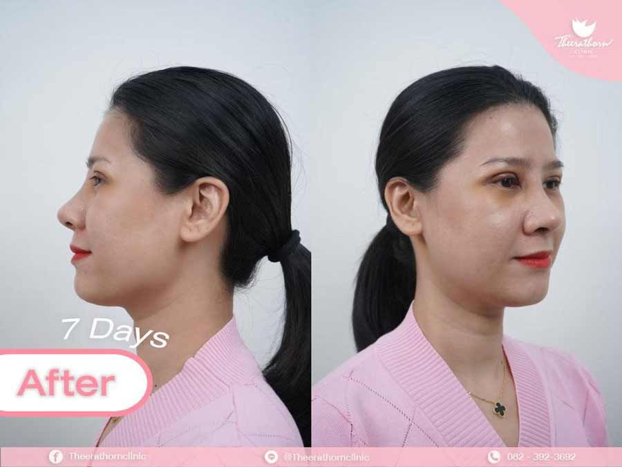 รีวิวแก้จมูก , กระดูกอ่อนหลังหู , sixlock