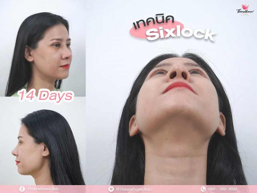 รีวิวแก้จมูก , กระดูกอ่อนหลังหู , sixlock