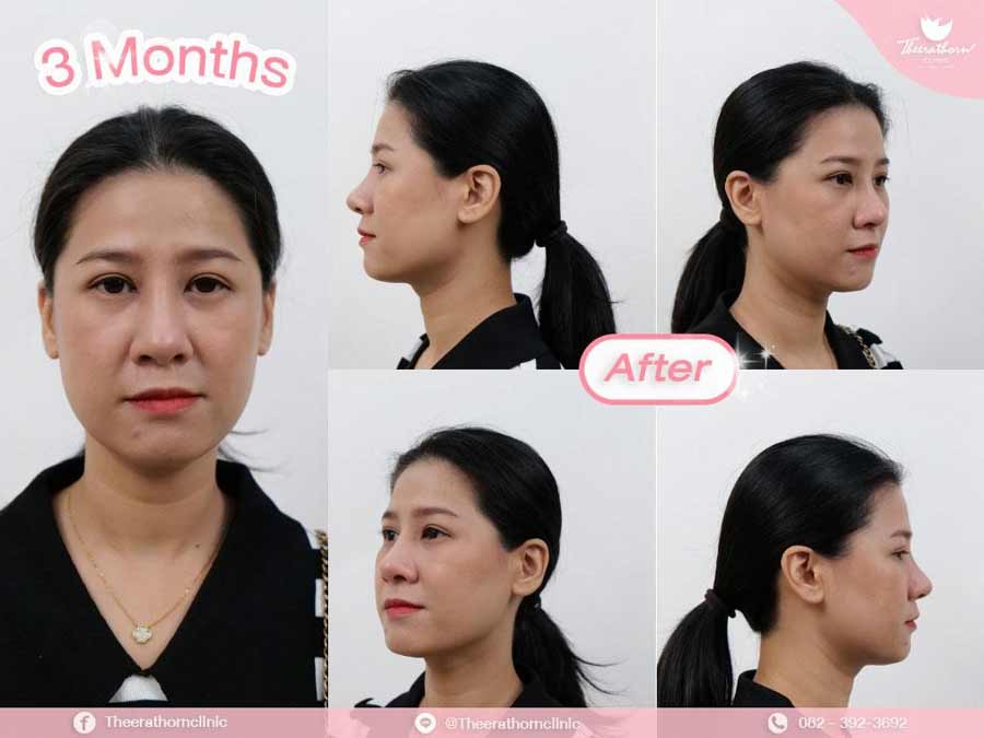 รีวิวแก้จมูก , กระดูกอ่อนหลังหู , sixlock