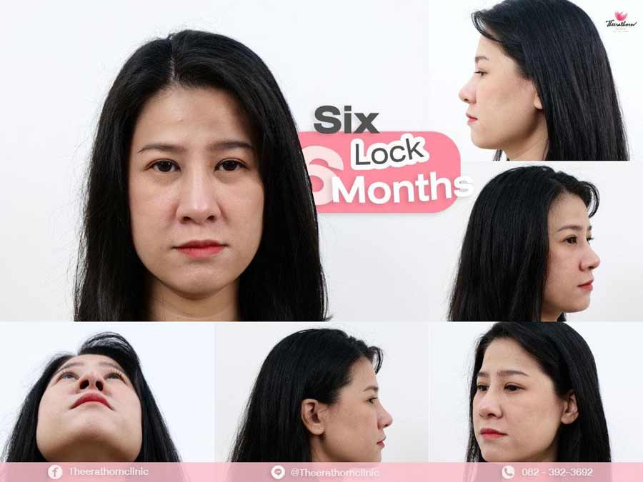 รีวิวแก้จมูก , กระดูกอ่อนหลังหู , sixlock