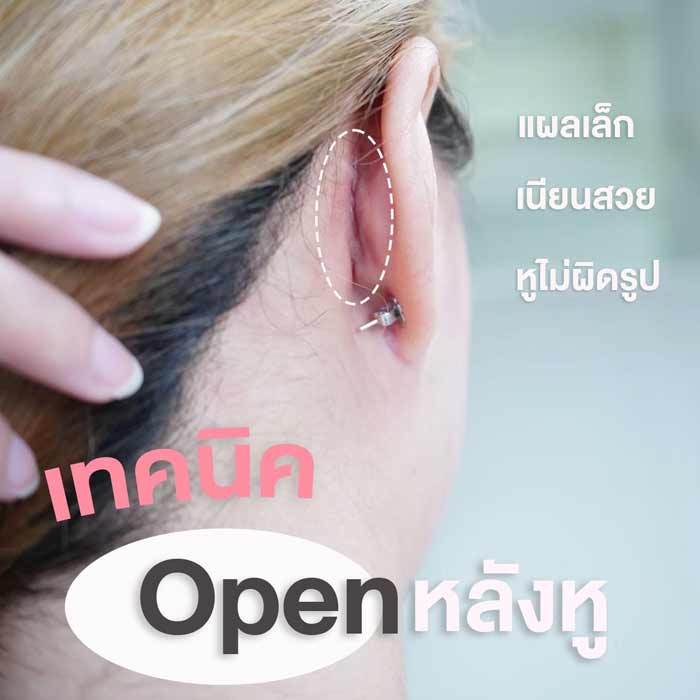 แผลโอเพ่นหลังหู