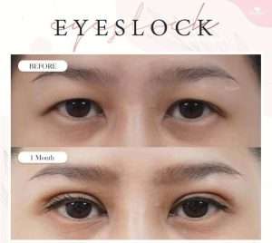 ตาสองชั้น , คลินิกทำตาสองชั้น , กรีดยาว
