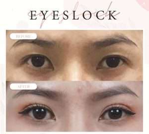ตาสองชั้น , คลินิกทำตาสองชั้น , กรีดยาว