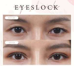 ตาสองชั้น , คลินิกทำตาสองชั้น , กรีดยาว
