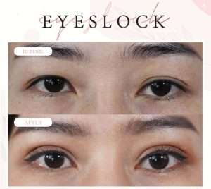 ตาสองชั้น , คลินิกทำตาสองชั้น , กรีดยาว