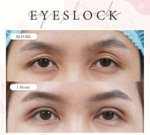 ตาสองชั้น , คลินิกทำตาสองชั้น , กรีดยาว