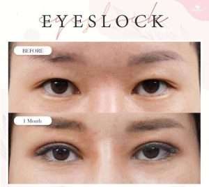 ตาสองชั้น , คลินิกทำตาสองชั้น , กรีดยาว