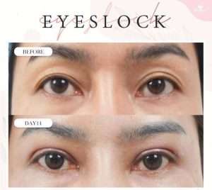 ตาสองชั้น , คลินิกทำตาสองชั้น , กรีดยาว