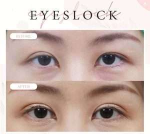 ตาสองชั้น , คลินิกทำตาสองชั้น , กรีดยาว