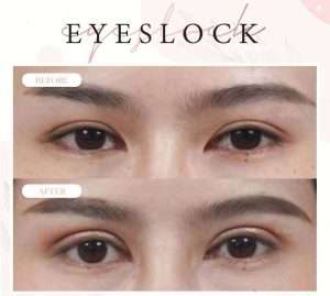 ตาสองชั้น , คลินิกทำตาสองชั้น , กรีดยาว