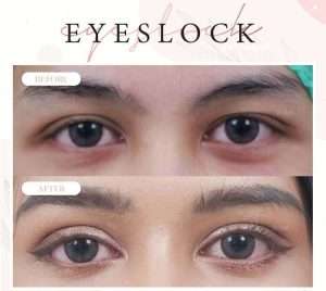 ตาสองชั้น , คลินิกทำตาสองชั้น , กรีดยาว