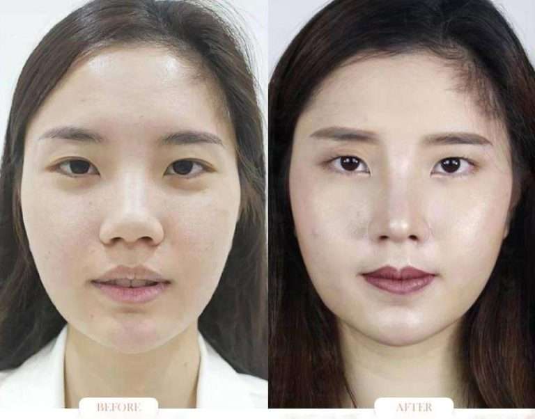 nose reduction , ลดขนาดจมูก