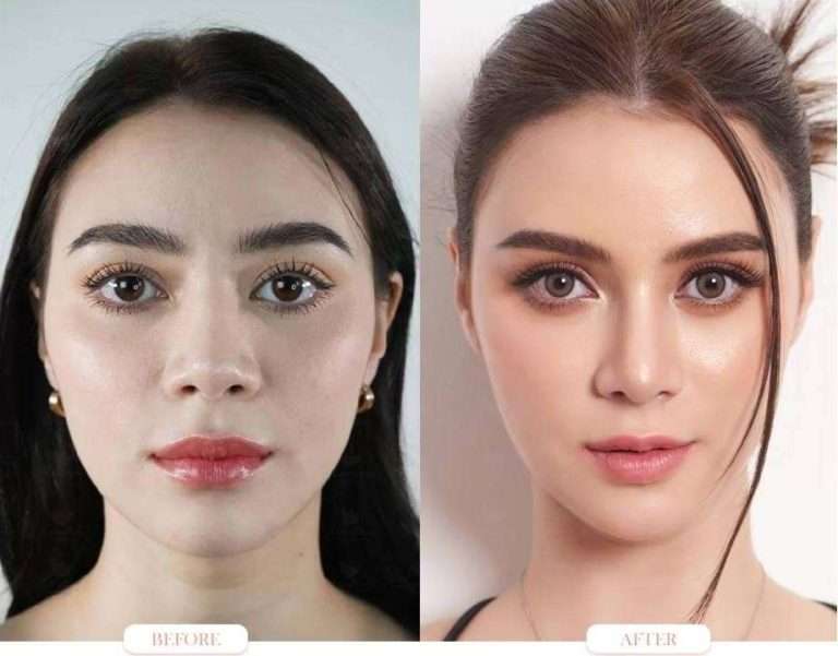nose reduction , ลดขนาดจมูก